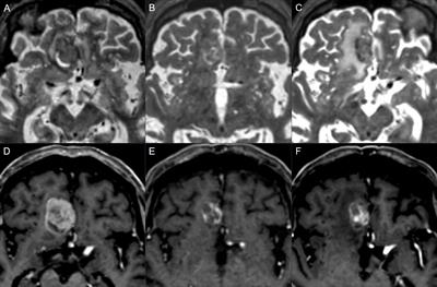 Single versus multiple fraction stereotactic radiosurgery for medium-sized brain metastases (4-14 cc in volume): reducing or fractionating the radiosurgery dose?